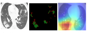 AI system detects SARS-CoV-2 on CT scans: DFKI presents method for image-based diagnosis of Corona